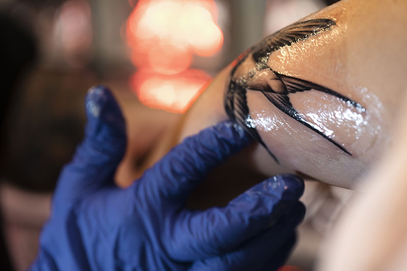 Después de la sesión eliminar tatuaje