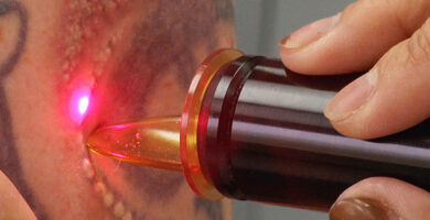 Eliminar tatuaje laser